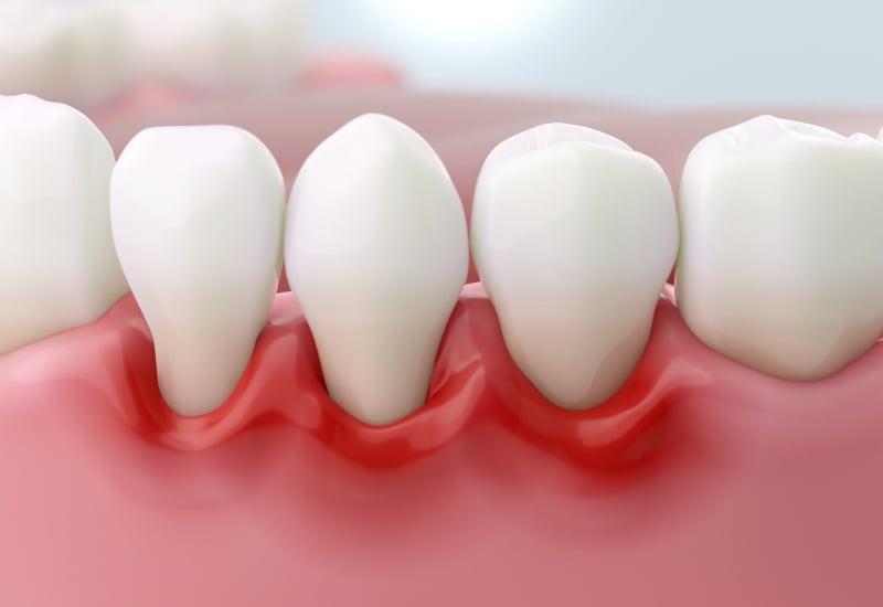 What are the signs you have gum disease?