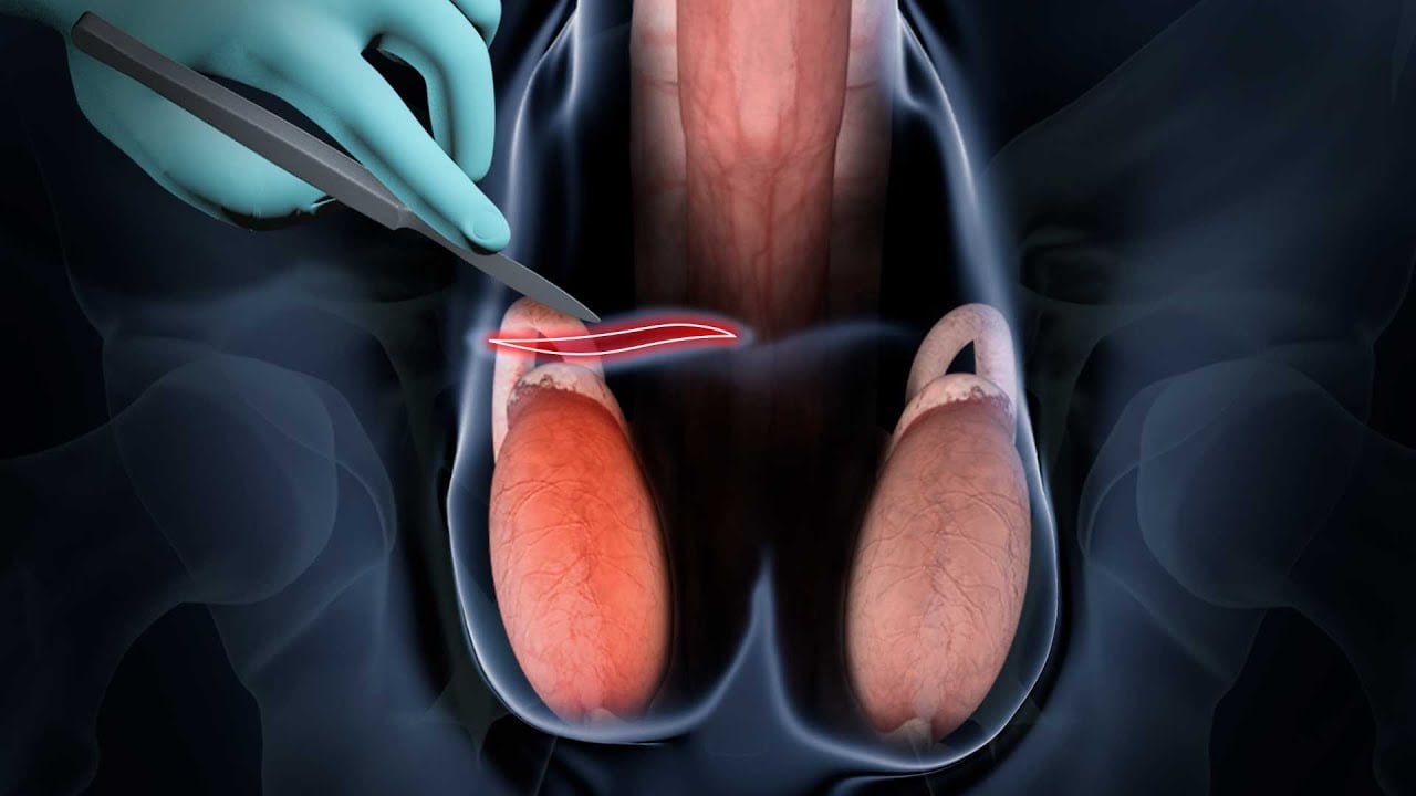 How to prepare for your vasectomy?