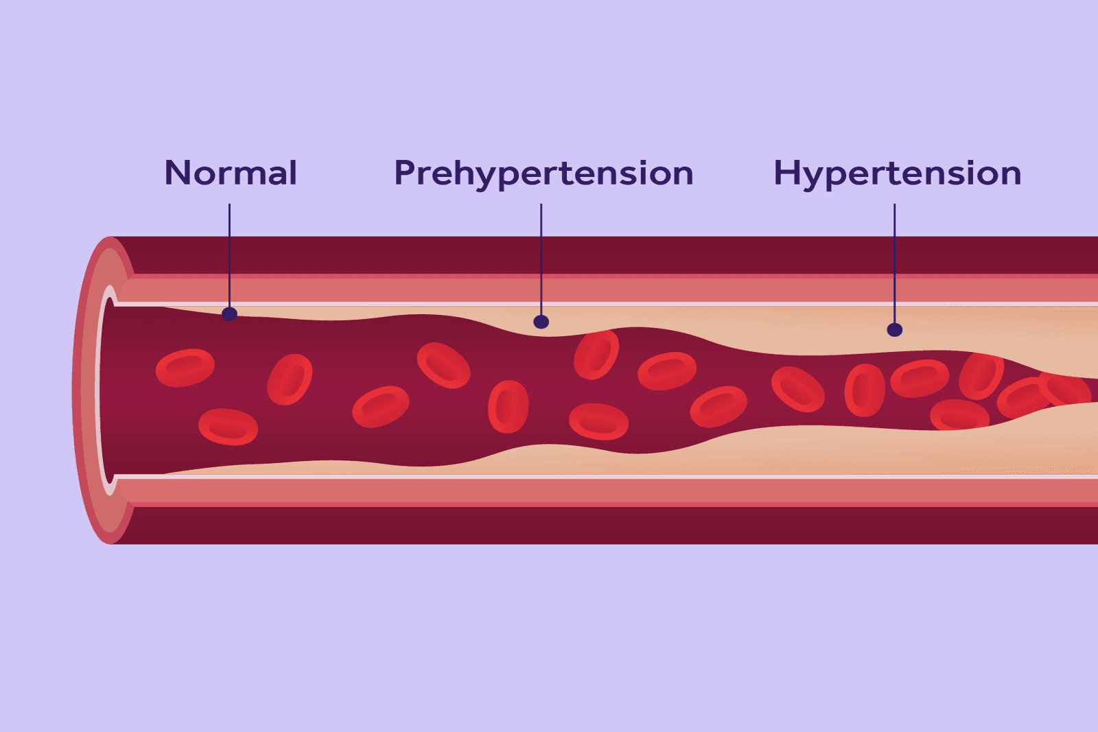 What Is High Blood Pressure?