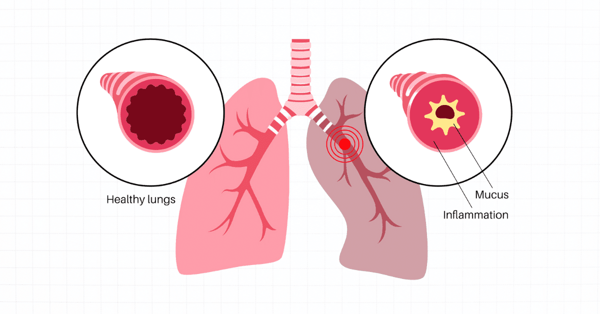 Symptoms of Emphysema
