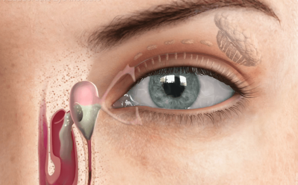 Dacryocystorhinostomy: External vs. Endonasal
