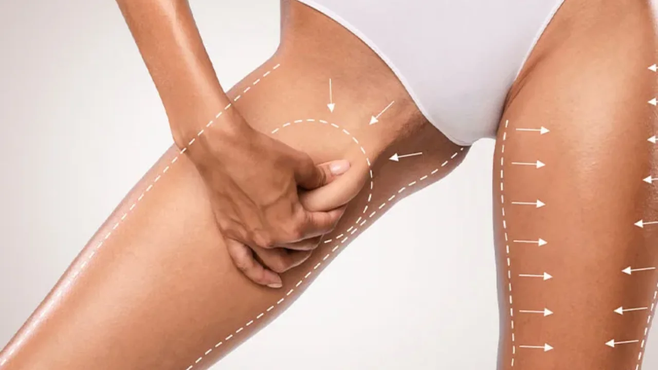 Thigh Lift with Liposuction
