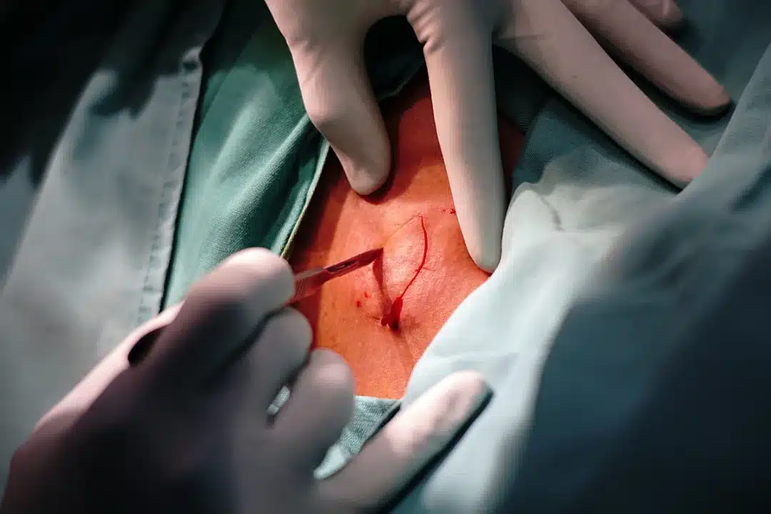 Excisional Biopsy