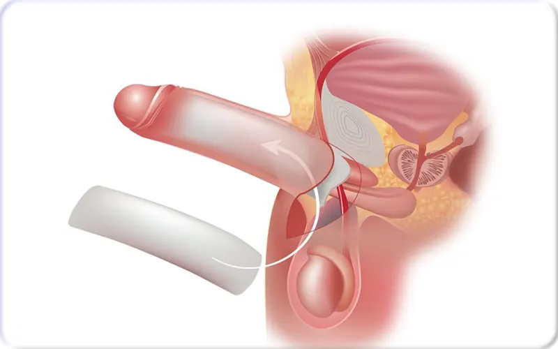 What Is Penis Enlargement Surgery?