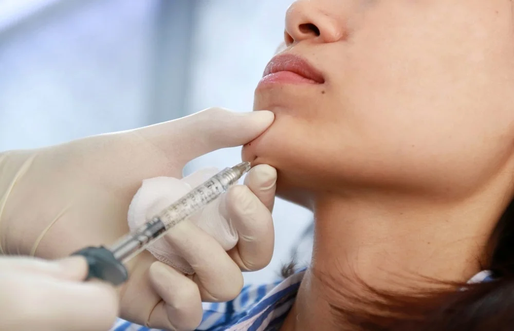 What Is Chin Filler?