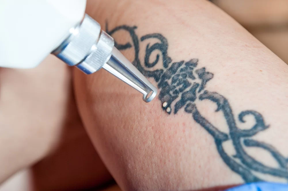 What Does Tattoo Removal Feel Like?