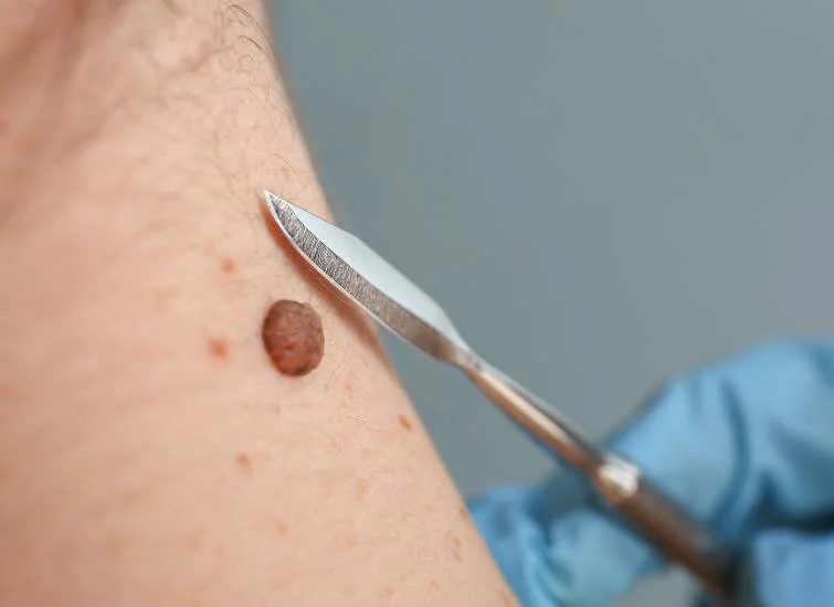 Why Are Moles Removed?