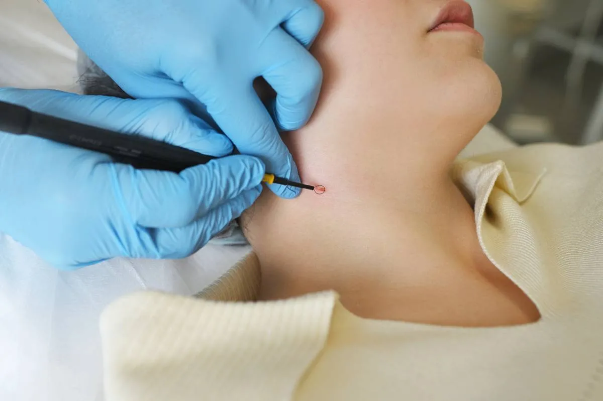 Which Mole Removal Method Will Be Used?