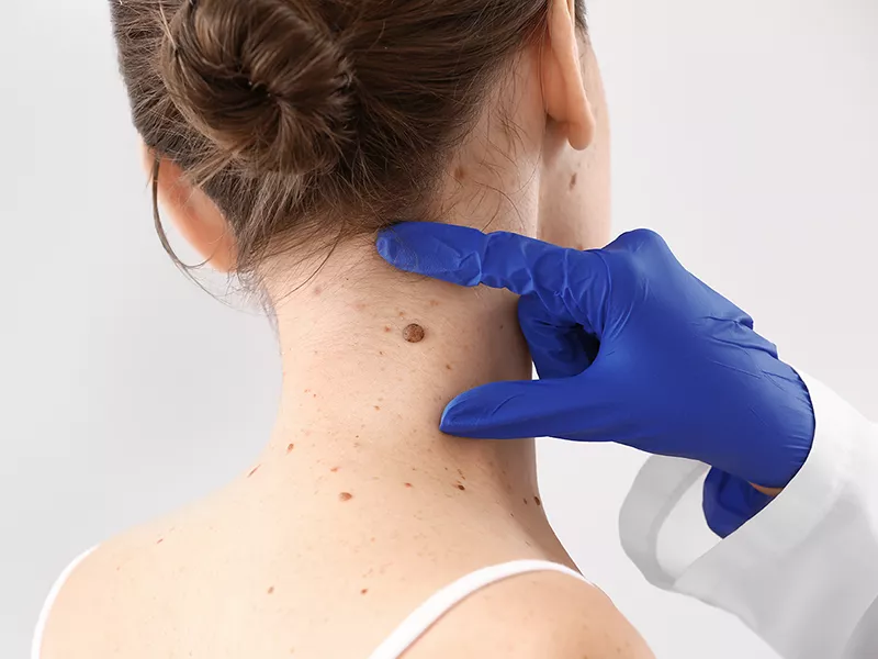 Surgical vs. Laser Mole Removal: Which Is Better?