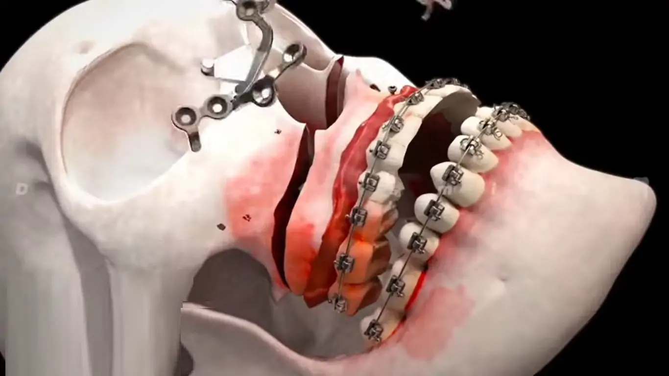 What are the Long-Term Side Effects of Jaw Surgery?