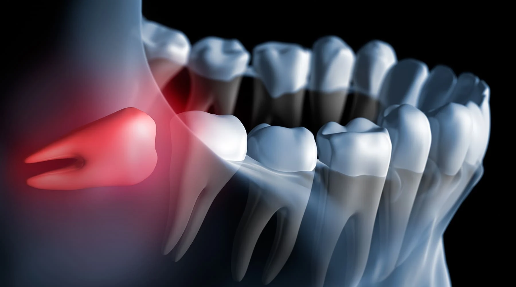 Should I have wisdom tooth removal?