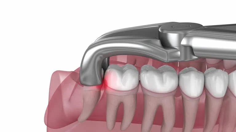 Do All Wisdom Teeth Need to Be Removed?