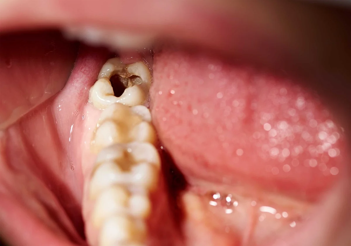 Is Wisdom Tooth Removal Painful?