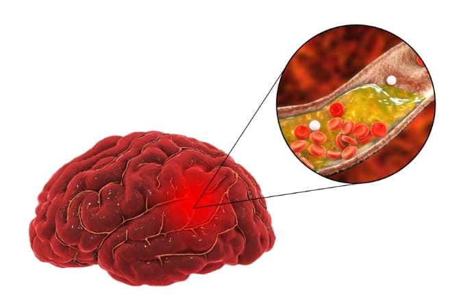 The Uses of Cerebrovascular Surgery
