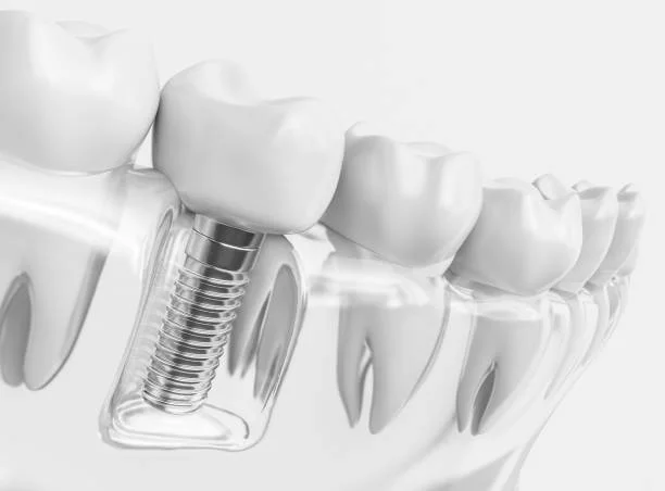 Dental Implant vs. Natural Teeth