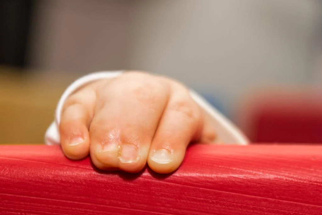 Why does Syndactyly occur & how is it treated?